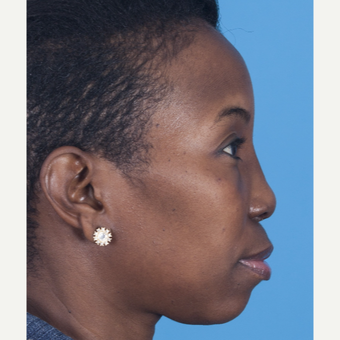 35-44 year old woman treated with African American Rhinoplasty after 3115286