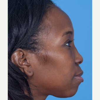 35-44 year old woman treated with African American Rhinoplasty before 3115286