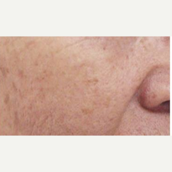 55-64 year old man treated with Age Spots Treatment after 3499340