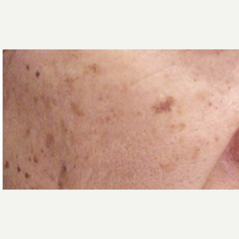 55-64 year old man treated with Age Spots Treatment before 3499340