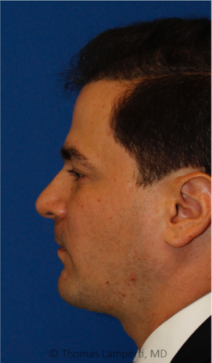Combined Sliding Genioplasty, Neck Liposuction and Rhinoplasty after 3672441