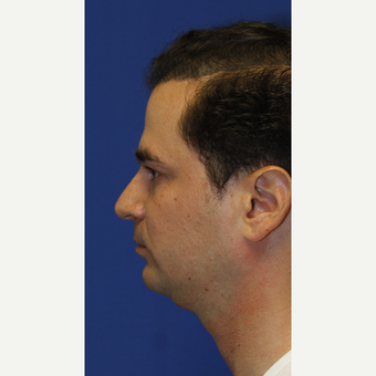 Combined Sliding Genioplasty, Neck Liposuction and Rhinoplasty before 3672441