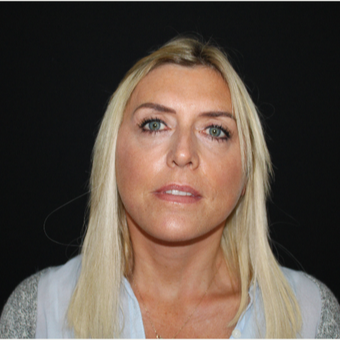 45-54 year old woman treated with Facelift after 3493956