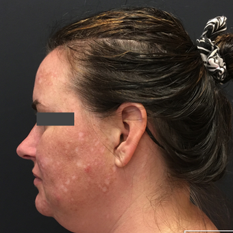 35-44 year old woman treated with Non-Surgical Neck Lift before 3665756