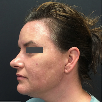 35-44 year old woman treated with Non-Surgical Neck Lift after 3665756