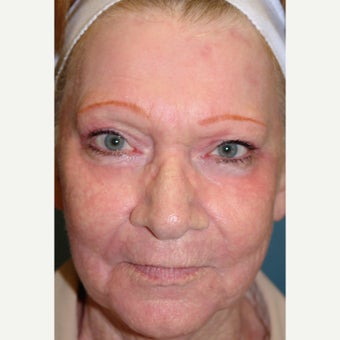65-74 year old woman treated with Dermabrasion after 1779762