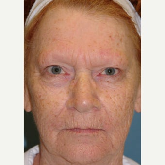 65-74 year old woman treated with Dermabrasion before 1779762