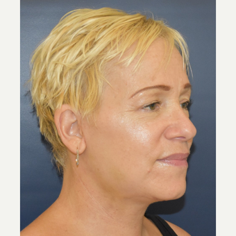 55-64 year old woman treated with Mini Lift after 3504016