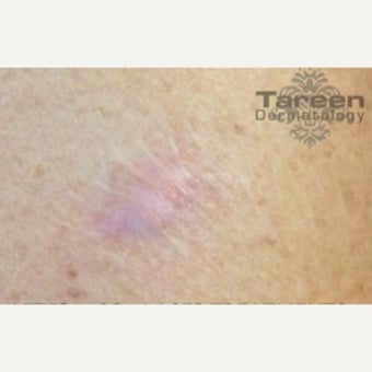 35-44 year old woman treated with Laser Resurfacing after 2081896