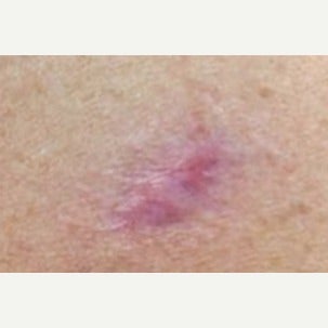 35-44 year old woman treated with Laser Resurfacing before 2081896