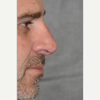 45-54 year old man treated with Rhinoplasty after 3566843