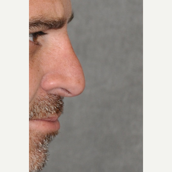 45-54 year old man treated with Rhinoplasty before 3566843