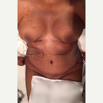 35-44 year old woman treated with Tummy Tuck, Breas lift and Liposuction after 3611264