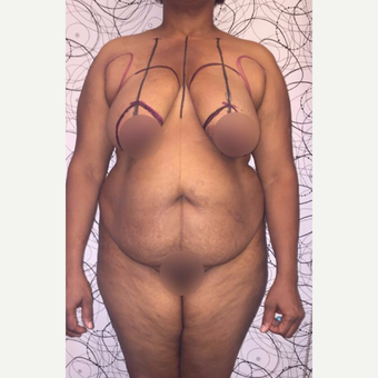 35-44 year old woman treated with Tummy Tuck, Breas lift and Liposuction before 3611264