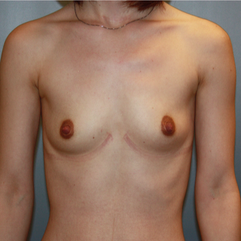 25-34 year old woman treated with Breast Augmentation before 3808770
