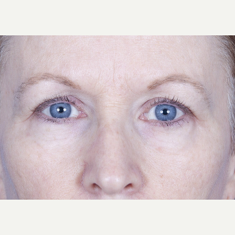 55-64 year old female 2 months after eyelid lift before 3471703