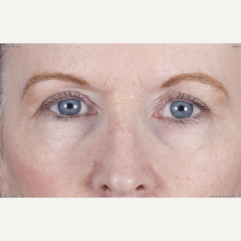 55-64 year old female 2 months after eyelid lift after 3471703