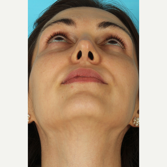 25-34 year old woman treated with Septoplasty after 3630411