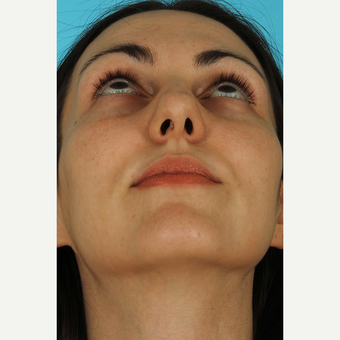 25-34 year old woman treated with Septoplasty before 3630411