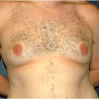 34 year old man treated with Male Breast Reduction before 3720905