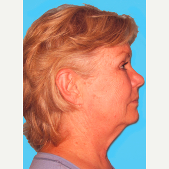 Facelift before 3824907