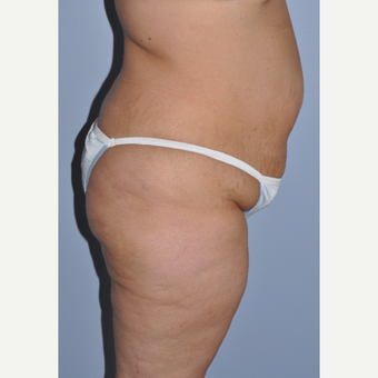 35-44 year old woman treated with Tummy Tuck before 3589986