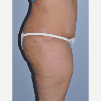 35-44 year old woman treated with Tummy Tuck after 3589986