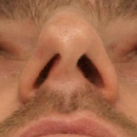 25-34 year old man treated with Rhinoplasty before 3442358