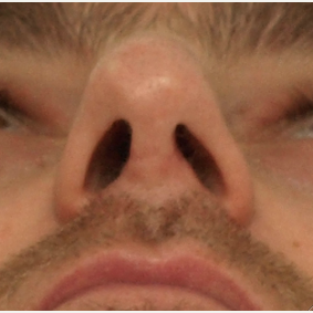 25-34 year old man treated with Rhinoplasty after 3442358