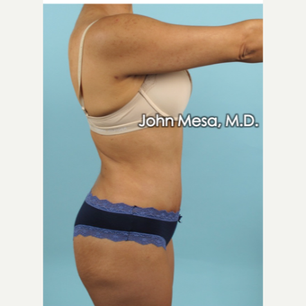 35-44 year old woman treated with Brazilian Tummy Tuck ( Lipo-Abdominoplasty) after 3659779
