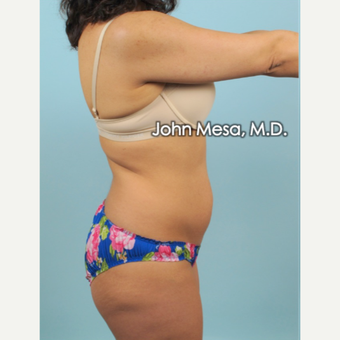 35-44 year old woman treated with Brazilian Tummy Tuck ( Lipo-Abdominoplasty) before 3659779
