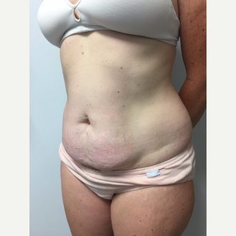 41 year old woman treated with Tummy Tuck and Liposuction before 3822279