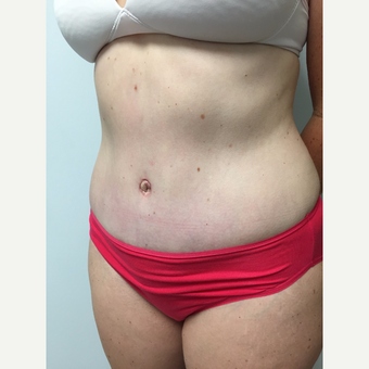 41 year old woman treated with Tummy Tuck and Liposuction after 3822279