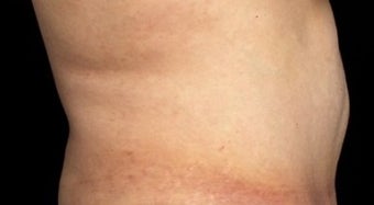 55-64 year old woman treated with CoolSculpting after 1801141
