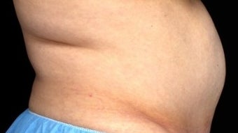 55-64 year old woman treated with CoolSculpting before 1801141