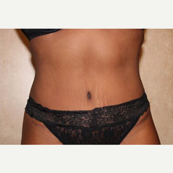 Tummy tuck with Liposuction after 3454611