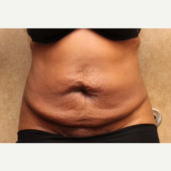 Tummy tuck with Liposuction before 3454611