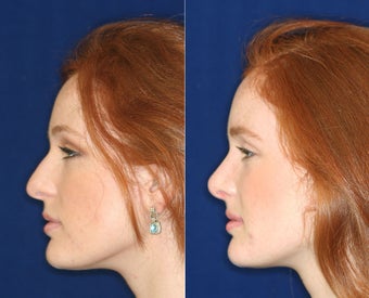 Nose Surgery before 1430624