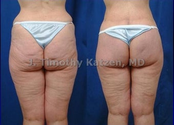 Before and after photo silicone buttock implant and lift after RNY gastric bypass after massive weight loss after 360 bodylift before 644274