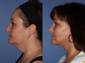 56 year old female, Neck Lift to improve neck and jaw line before 1331555
