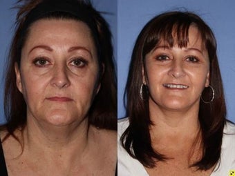 56 year old female, Neck Lift to improve neck and jaw line 1331555