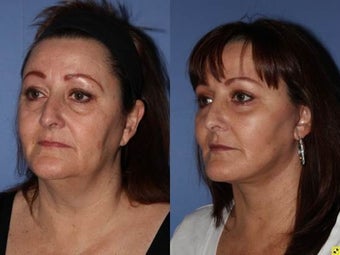 56 year old female, Neck Lift to improve neck and jaw line after 1331555