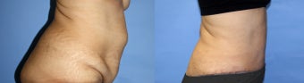 Abdominoplasty/Tummy Tuck before 1164941