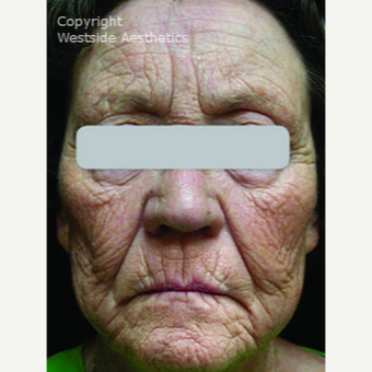 Deep Skin Resurfacing before 3075696