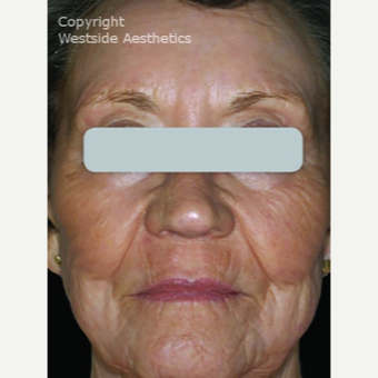Deep Skin Resurfacing after 3075696