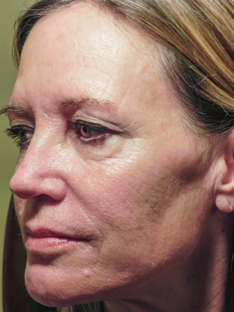 55 year old woman treated with Lower Eyelid Surgery and Full Face RESET Laser Skin Resurfacing before 1930129