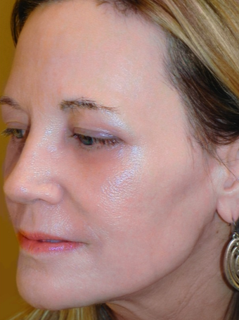 55 year old woman treated with Lower Eyelid Surgery and Full Face RESET Laser Skin Resurfacing after 1930129