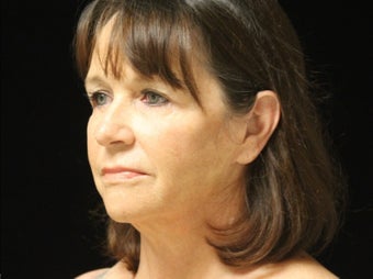 55-64 year old woman treated with Facelift, quad blepharoplasty, liposuction 2509095