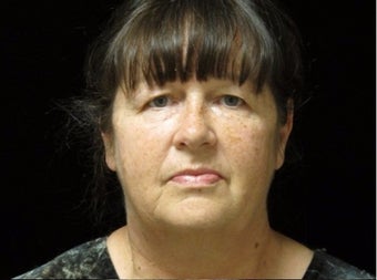 55-64 year old woman treated with Facelift, quad blepharoplasty, liposuction before 2509095