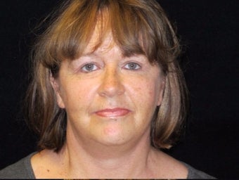 55-64 year old woman treated with Facelift, quad blepharoplasty, liposuction after 2509095